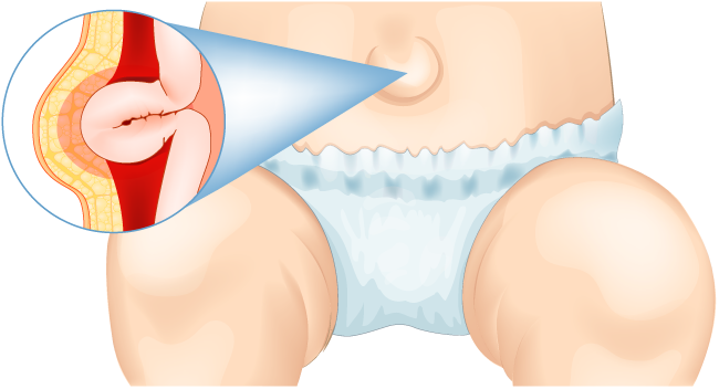Hernia umbilical