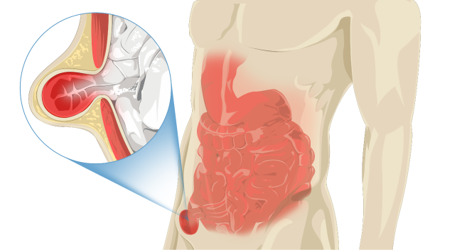 Hernia umbilical