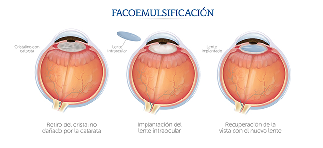 Fases de una cirugía de cataratas