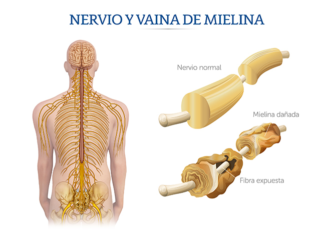 Ilustraci&oacute;n el efecto del s&iacute;ndrome Guillen-Bar&eacute; en los nervios